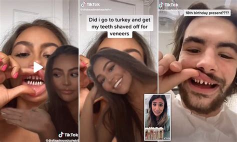 Dentists Urge Social Media Users Not To Embrace Trend That Involves