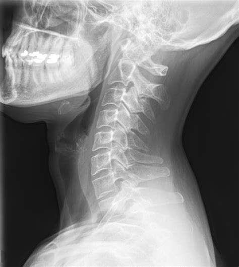 The Value Of X Ray In Chiropractic Treatment Brookfield Chiropractor