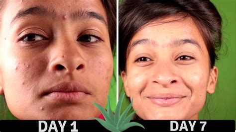 7 Days Experiment With Aloe Vera On Acne Youtube