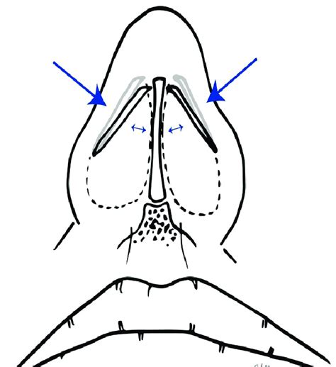 Internal Nasal Valve Narrowing And Collapse This May Be Prevented By