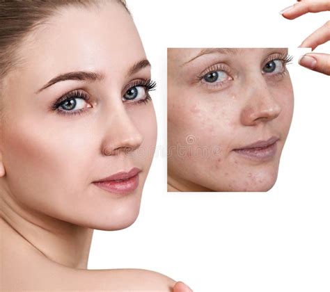 Woman Shows Photo With Bad Skin Before Treatment Stock Photo Image