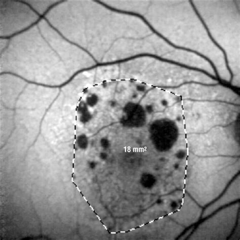 Symmetry Of Bilateral Lesions In Geographic Atrophy In Patients With