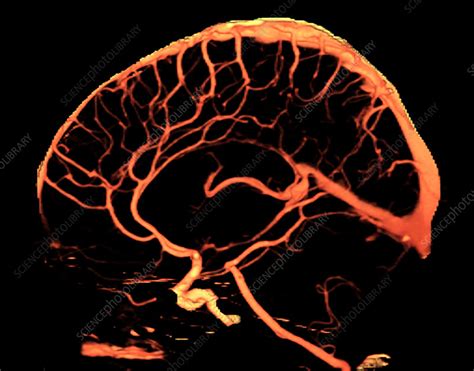 Normal Cerebral Vasculature 3d Ct Angiogram Stock Image C0306483