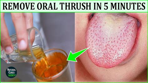 How To Get Rid Of Oral Thrush Naturally In 5 Minutes Oral Thrush Home Remedies Dental