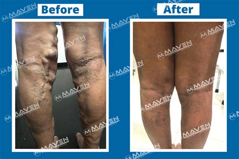 Varicose Veins Laser Treatment Before After Pictures At Maven Medical