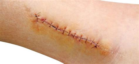 Sutures And Surgical Wounds How To Care For Them Properly