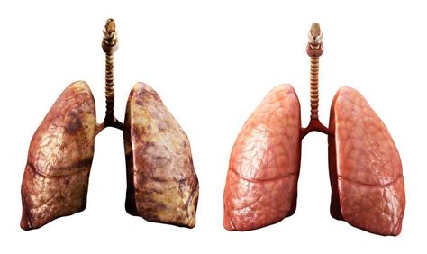 Randomized Prospective Trial Suggests Ai Improves Lung Cancer Screening
