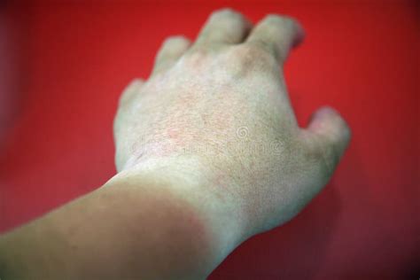 Sunburnt Hand Stock Image Image Of Colors Sunscreen 5143103