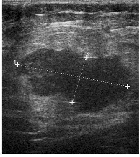 An Ultrasound Image Of An Enlarged Abnormal Lymph Node Demonstrating