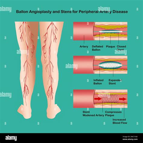 Diagram Showing Angioplasty For Peripheral Artery Disease Illustration