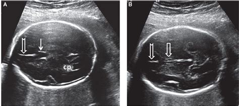 Normal Fetal Brain Ultrasound