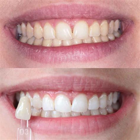 Enlighten Teeth Whitening Far Headingley Dental Care Leeds