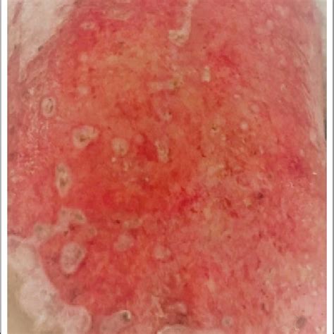 Pdf Eczema Herpeticum In Children With Burns