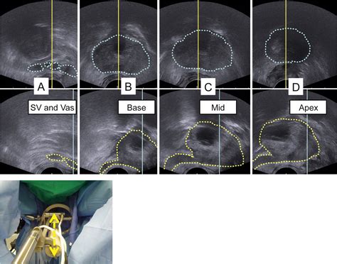 Robotic Transrectal Ultrasonography During Robot Assisted Radical