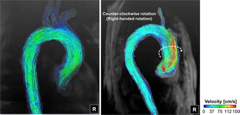 Representative Helical Flow Pattern In The Ascending Aorta R