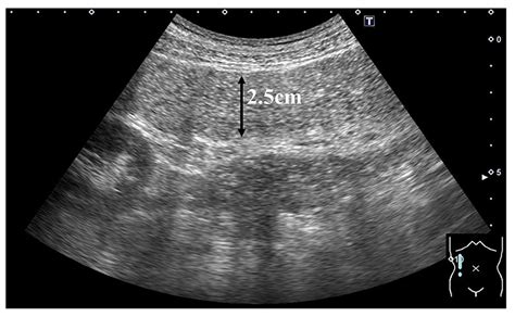 Ultrasonographic Evaluation Of Large Bowel Obstruction With Fecal