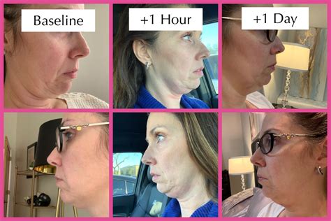 My Kybella Experience Day 1 Before And After Photos Copper State Style