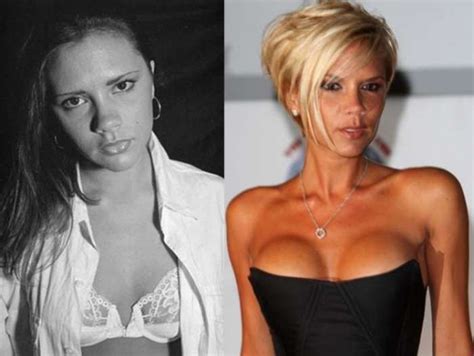 Celebrity Plastic Surgery Fails Before And After Celebrity Plastic