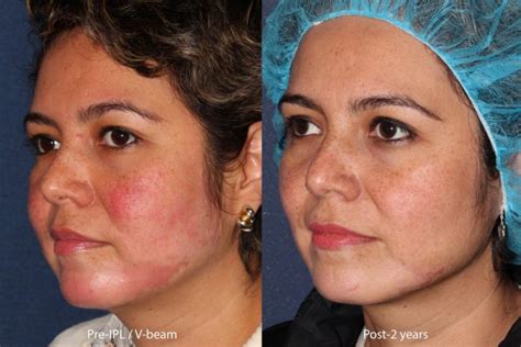 treating rosacea with ipl cosmetic laser dermatology skin specialists in san diego