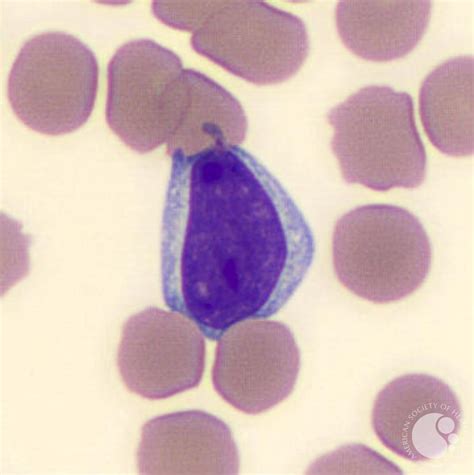 Reactive Lymphocyte