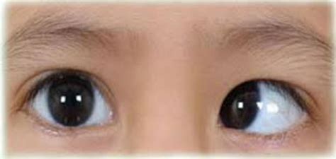 Squint Surgery Age Limit For Children And Adults Eyemantra