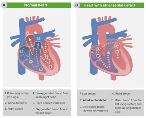 Atrial Septal Defect Asd Concise Medical Knowledge