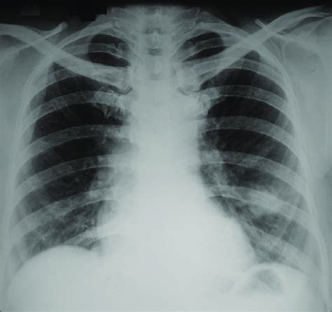 Chest X Ray Posteroanterior View Showing Heterogeneous Opacity With
