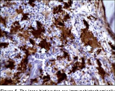 Figure 1 From Imaging Features Of Isolated Extranodal Rosai Dorfman