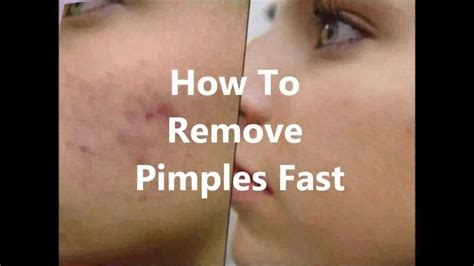 5 Easy Ways To Get Rid Of Pimples Instantly Guaranteed Results Youtube