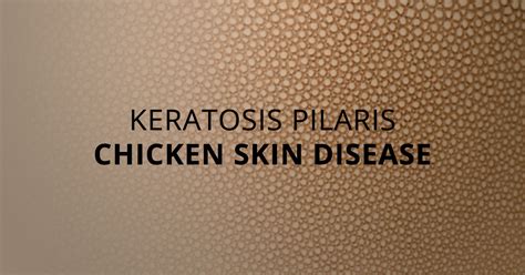 Everything You Need To Know About Chicken Skin Disease Marham