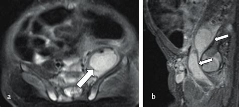 Axial A And Sagittal B T2 Weighted Images Of Mri Shows Multiple