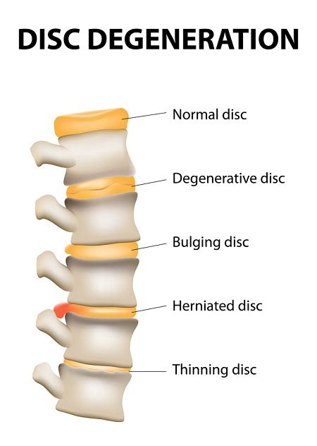 Disc Degeneration In Lower Back 6 Ways To Recover Naturally And Fast