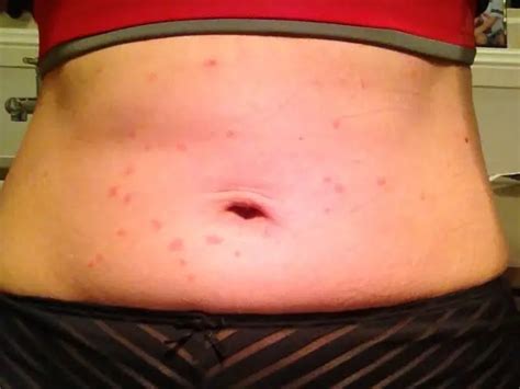 Sea Lice Bites Ouch How To Treat Sea Lice Bites And How To Avoid
