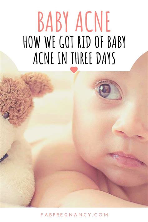 How To Get Rid Of Baby Acne Baby Acne Baby Acne Remedy Baby Grooming