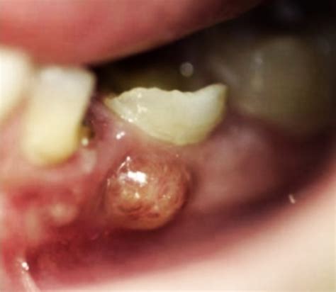 Gum abscess treatment involves eliminating the cause of the infection and draining the buildup of pus. What to do about a fistula on the gums?