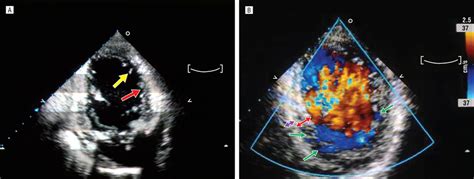 Echocardiogram And Color Doppler Imaging A Echocardiogram Shows