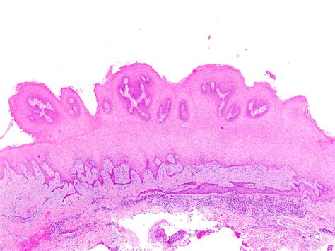 Squamous Papilloma Uvula Pathology Outlines Squamous Papilloma Uvula