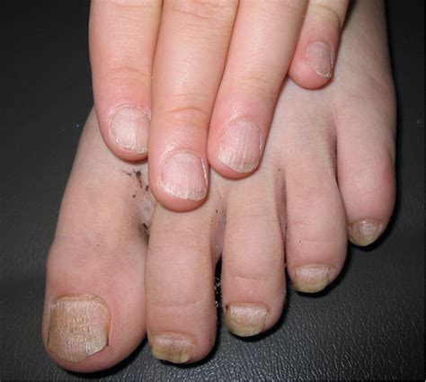 An Atlas Of Nail Disorders Part 15 Consultant360