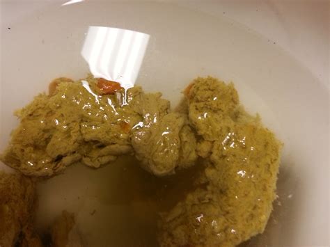 It has a role in digestion and in regulating the level of sugar in your blood. Pancreas: Yellow Stool Pancreas
