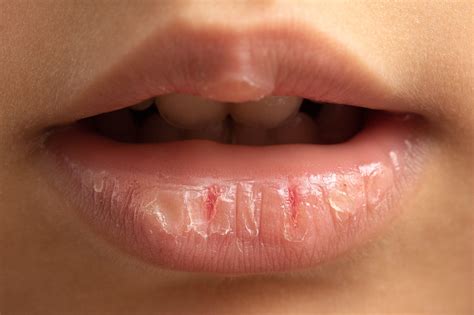 Chapped Lips Rescue Your Pout Averr Aglow