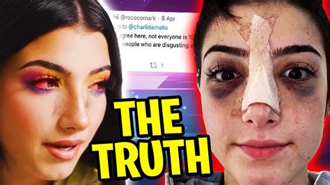 Why Did Charli Damelio Get Surgery The Hidden Truth Youtube