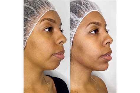 How To Straighten Your Jawline Without Surgery | Justinboey