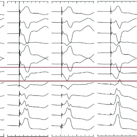 Twelve Lead Electrocardiogram ECG And Electrogram Showing The Change