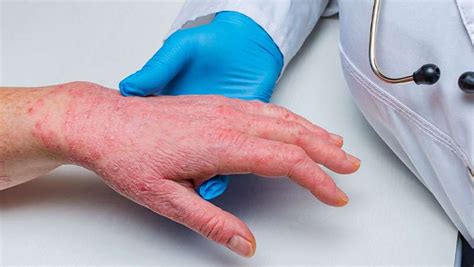 Dermatitis At Pica Todo Lo Que Debes Saber