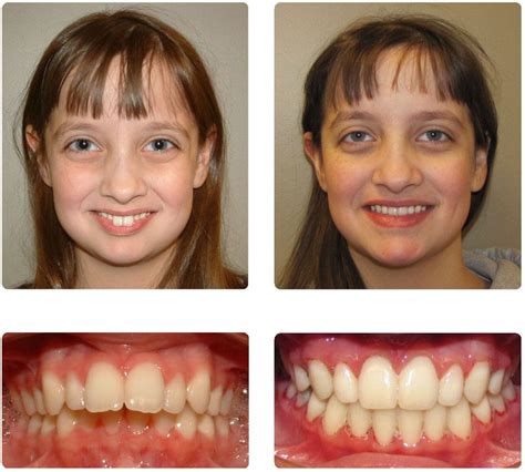 Overbite Correction