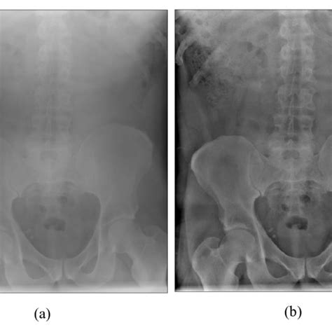 A An Adult Abdomen Radiograph Taken With 75 Kvp 16 Mas And Without