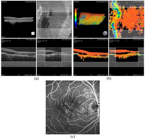 3d Ps Oct Dataset Of The Retina And Rpe Layer Of An Amd Patient With