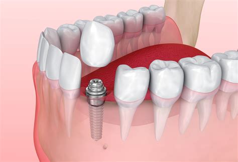 Dental Implant Crown Replacement Cost at Floyd Calloway blog