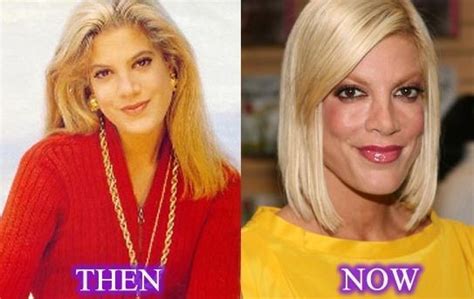Tori Spelling Before And After Plastic Surgery 09 Celebrity Plastic