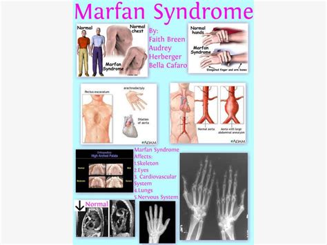 Marfan Syndrome Arlington Tx Patch
